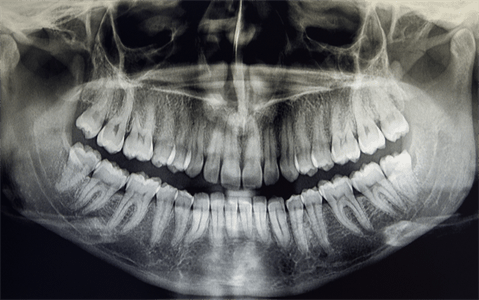 親知らずは虫歯や歯周病の原因にもなります。