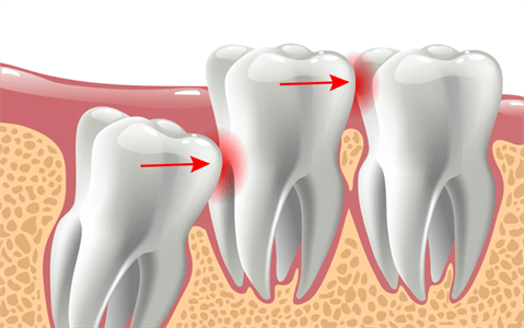 親知らずにより、歯肉が腫れ、頬が痛む症状が出る場合もあります。